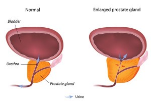 Why does your prostate enlarge?